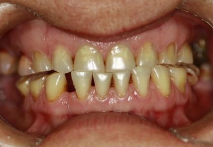 Respingerea implanturi dentare - simptome, semne, cauze
