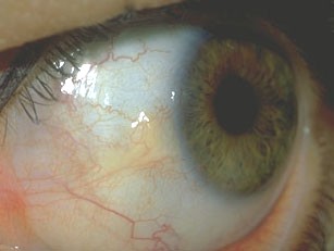 PINGUECULA ochi cauze, tratament (remedii populare, picături, îndepărtarea laser) pot