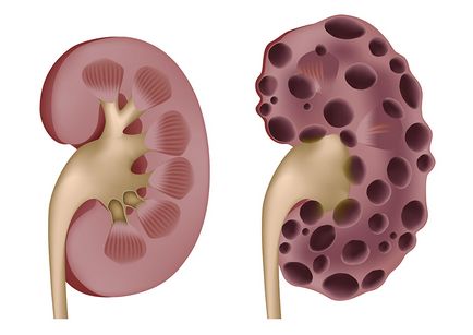 Polichistic simptomele bolii de rinichi, medicamente, dieta si populare remedii cu rinichi polichistic