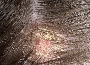 dermatita seboreica a scalpului tratament, motivele - articolul pe - versiunea PDA