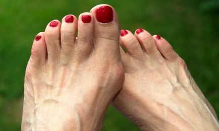 Denivelările pe degetele de la picioare cauze si tratament