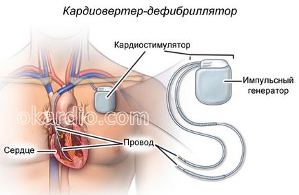 Sindromul de repolarizării ventriculare precoce ce este manifestarea pe ECG