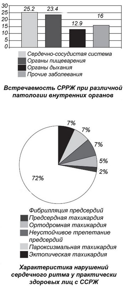 Sindromul de repolarizării ventriculare precoce ce este manifestarea pe ECG