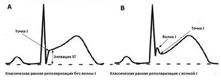 Sindromul de repolarizării ventriculare precoce ce este manifestarea pe ECG