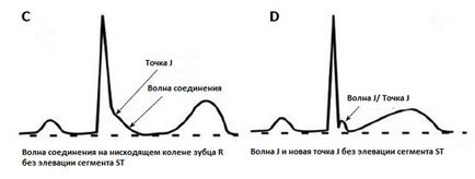 Sindromul de repolarizării ventriculare precoce ce este manifestarea pe ECG