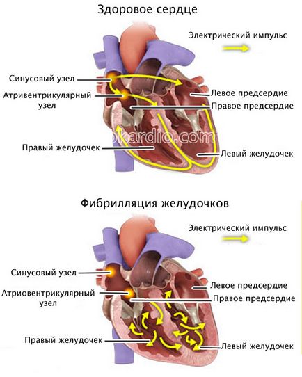 Sindromul de repolarizării ventriculare precoce ce este manifestarea pe ECG