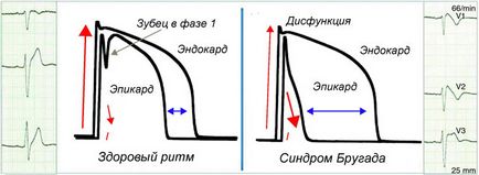 Sindromul de repolarizării ventriculare precoce ce este manifestarea pe ECG