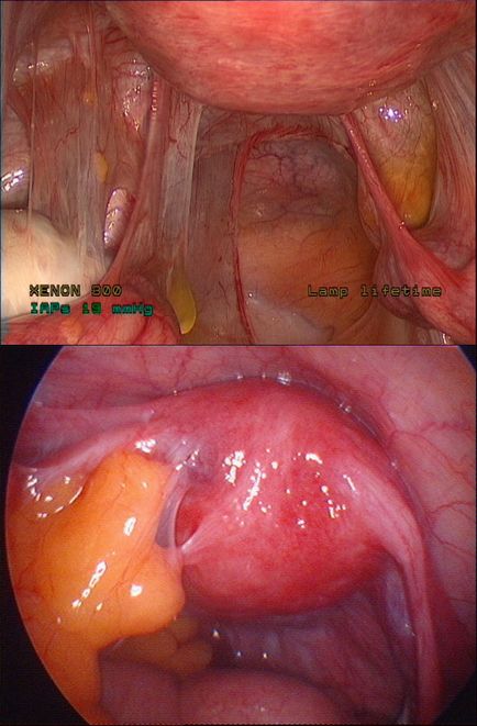 Adeziunilor simptome pelvine, diagnostic, tratament, complicații