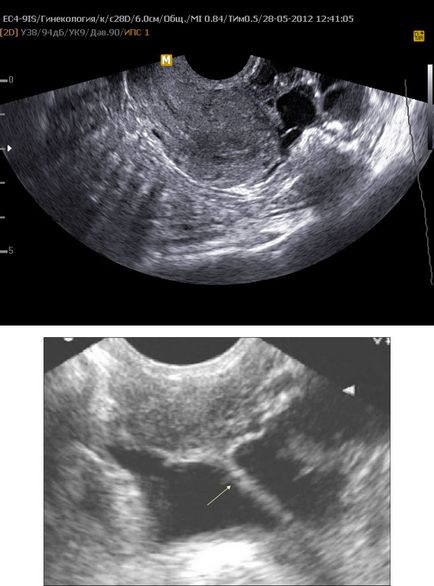 Adeziunilor simptome pelvine, diagnostic, tratament, complicații