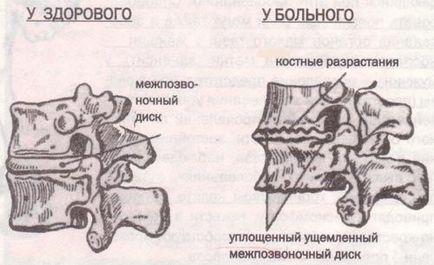 Spondiloza simptome coloanei cervicale, tratament