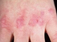 Fisuri de pe mâini și degete (pe bile, sfaturi, falduri între ele), cauze și fotografii de tratament