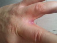 Fisuri de pe mâini și degete (pe bile, sfaturi, falduri între ele), cauze și fotografii de tratament