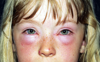 Un copil sub ochi umflarea - cauze si tratament