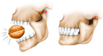 Tratamentul maxilarului dislocat, simptome și de prim ajutor