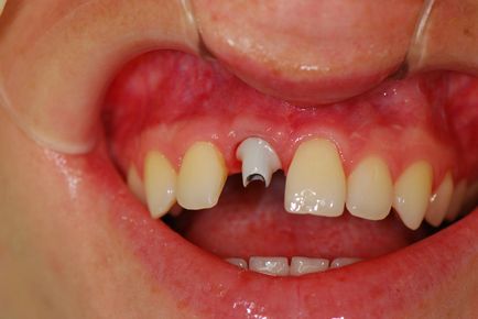 coroane temporară de producție de dinți, pret, foto, comentarii