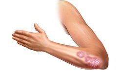 Intriga tratamentului anginei copiilor de la rugăciunile de angină (angină pectorală) Intriga tratamentului anginei copiilor de la rugăciuni anginoase
