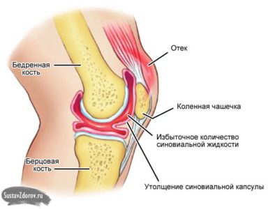 Lichidul din remediile populare genunchiului tratament comun