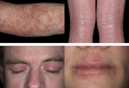 Alergii la simptome acarianul de praf, de tratament, în special la copii