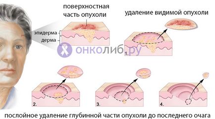 Carcinomul bazocelular a simptomelor pielii, tratarea și eliminarea, foto