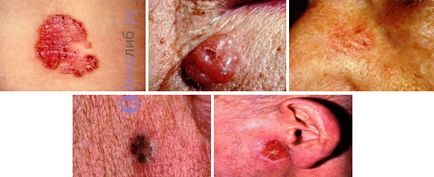 Carcinomul bazocelular a simptomelor pielii, tratarea și eliminarea, foto