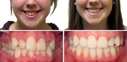 Bretele înainte și după - fotografie dentiști lucrează