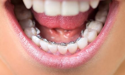 Bretele înainte și după - fotografie dentiști lucrează