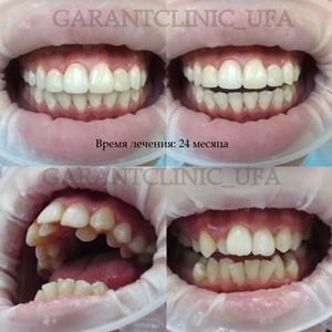 Bretele, clinica moderna stomatologie „garant“ (sistem de tratare ortodontice) Bretele, clinica moderna stomatologie „garant“