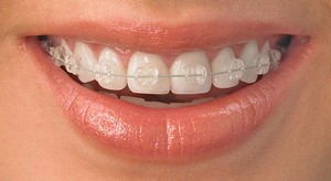 Acolade, clinica moderna stomatologie „garante“ (între paranteze) tratament ortodontic Bretele, clinica moderna stomatologie „garant“