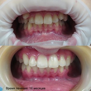 Bretele, clinica moderna stomatologie „garant“ (sistem de tratare ortodontice) Bretele, clinica moderna stomatologie „garant“
