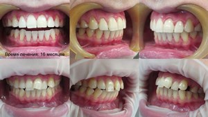 Acolade, clinica moderna stomatologie „garante“ (între paranteze) tratament ortodontic Bretele, clinica moderna stomatologie „garant“