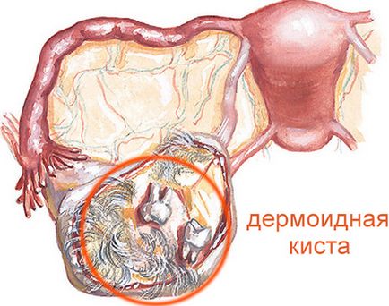 Dermoid cauze chist ovarian, simptome și tratament, consecințele chirurgie
