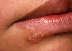 Herpes pe buze - cauze, simptome si tratamentul herpesului
