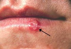 Herpes pe buze - cauze, simptome si tratamentul herpesului