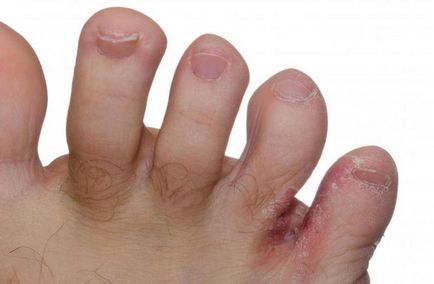 Fungus între degetele de la picioare tratament la domiciliu în mod eficient