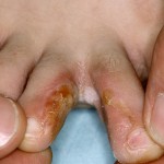 Fungus între degetele de la picioare verifica simptomele, pentru a alege un tratament