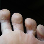 Fungus între degetele de la picioare verifica simptomele, pentru a alege un tratament
