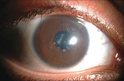 Cum de a trata un ochi distrofii retiniene metode eficiente