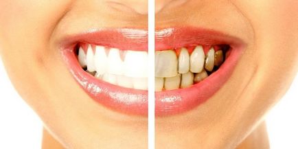 Cum de a elimina placa dentară la domiciliu - metode pentru indepartarea petelor de culoare închisă și galben