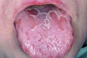 Tratamentul limba glosita la căi de atac acasă populare