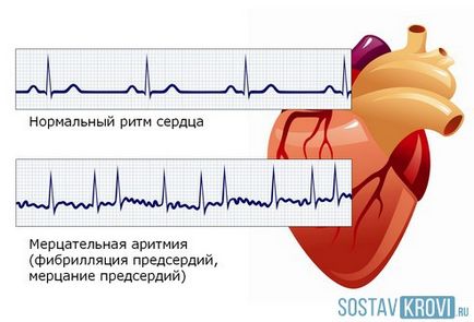 tulburare de ritm cardiac cauze, tipuri, simptome, diagnostic si tratament de aritmie