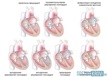 tulburare de ritm cardiac cauze, tipuri, simptome, diagnostic si tratament de aritmie