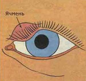 motive Umflarea superioare ochi pleoapei, care fac tratament