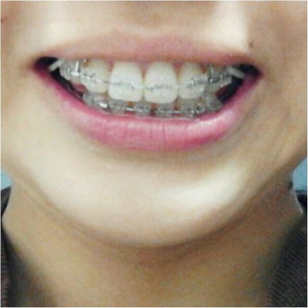 Ortodonție in stomatologie - de ce a pus aparat dentar, de ce musca fix, de ce a pus aparat dentar