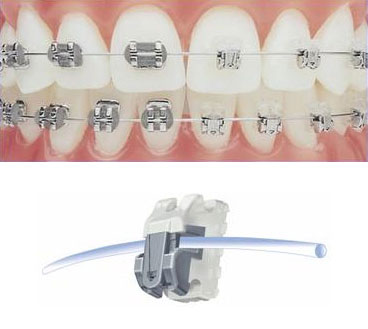 Ortodonție in stomatologie - de ce a pus aparat dentar, de ce musca fix, de ce a pus aparat dentar