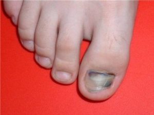 Din ceea ce unghiile mari pe degetele de la picioare transformat albastru