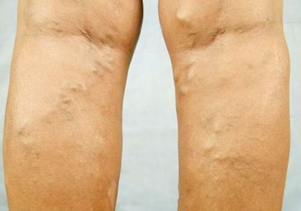 Umflarea picioarelor la vârstnici simptomele și tratamentul mucegaiului