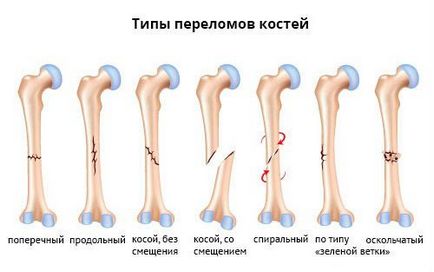 fracturi osoase și clasificarea (care sunt), complicații