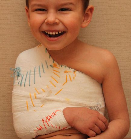 Tratamentul fracturii de clavicula la copii și efectele