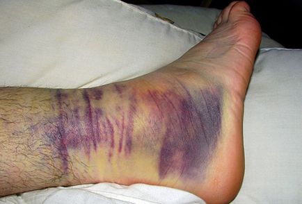 Simptomele picior rupt, perioadele de tratament și recuperare