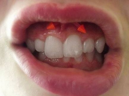 Piercing Smiley - fotografii, durere, consecinte, riscuri, pret